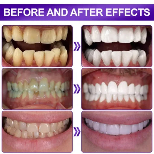 Flysmusยฎ Whitening Strips