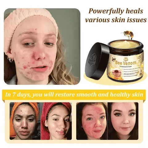 TLOPA® Bee Venom Skin Treatment Cream