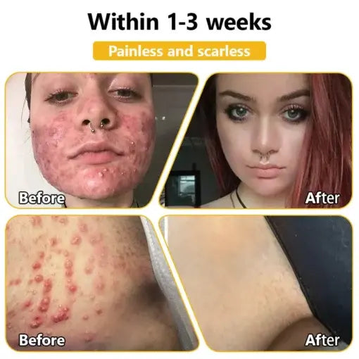 TLOPA® Bee Venom Skin Treatment Cream
