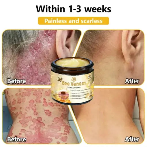 TLOPA® Bee Venom Skin Treatment Cream