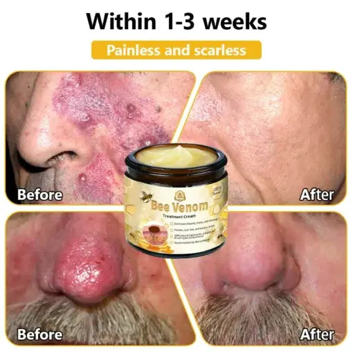 TLOPA® Bee Venom Skin Treatment Cream