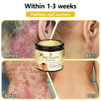 TLOPA® Bee Venom Skin Treatment Cream